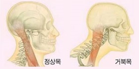 스마트폰으로 인해 발생하는 질병예방법