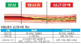 생활습관병을 극복하자－9 심장병